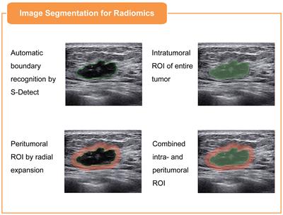 Development of an interpretable machine learning model for Ki-67 prediction in breast cancer using intratumoral and peritumoral ultrasound radiomics features